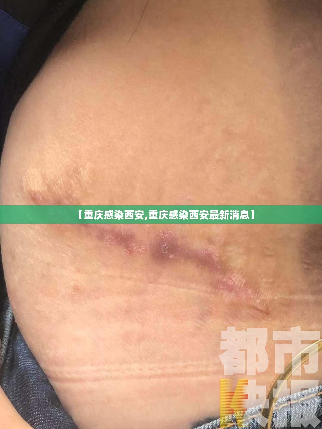【重庆感染西安,重庆感染西安最新消息】